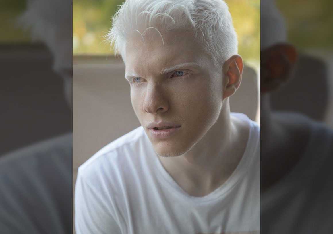 Альбинос с голубыми глазами
